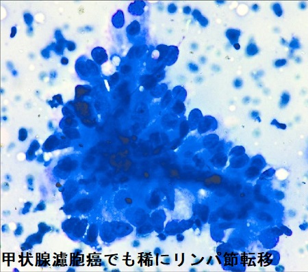 甲状腺濾胞癌でもリンパ節転移 細胞診 甲状腺濾胞癌でもリンパ節転移 細胞診