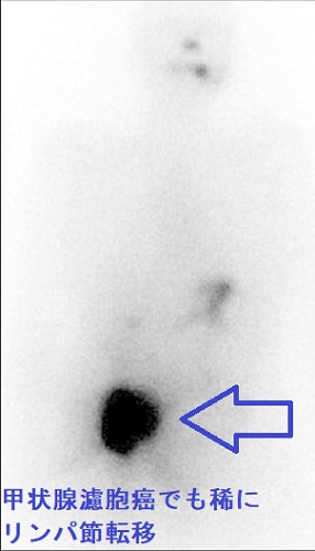甲状腺濾胞癌でもリンパ節転移 131Iシンチグラフィー 甲状腺濾胞癌でもリンパ節転移 131Iシンチグラフィー
