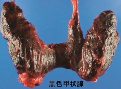 黒色甲状腺 黒色甲状腺