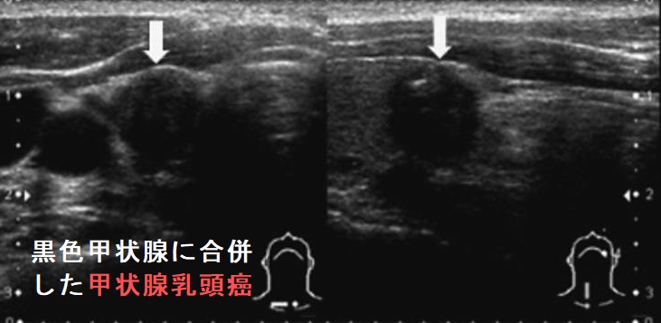 黒色甲状腺に合併した甲状腺腫乳頭癌 超音波(エコー)画像 黒色甲状腺に合併した甲状腺腫乳頭癌 超音波(エコー)画像