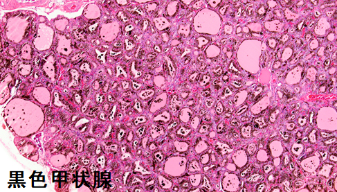 黒色甲状腺 病理組織 黒色甲状腺 病理組織