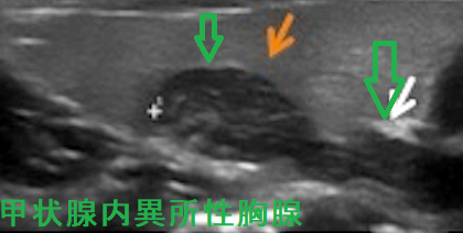 甲状腺内異所性胸腺 超音波(エコー)画像 甲状腺内異所性胸腺 超音波(エコー)画像