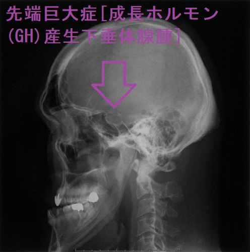 先端巨大症（成長ホルモン産生下垂体神経内分泌腫瘍）と甲状腺