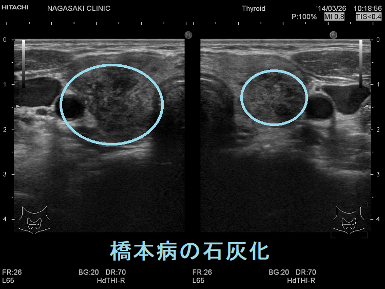 橋本病の多発性局所性石灰化 超音波(エコー)画像 橋本病の多発性局所性石灰化 超音波(エコー)画像