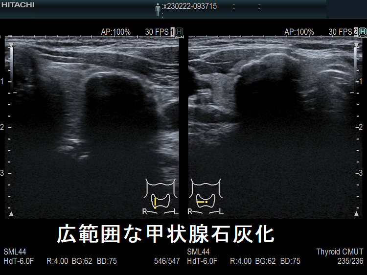 甲状腺内 線状石灰化 超音波(エコー)画像 甲状腺内 線状石灰化 超音波(エコー)画像