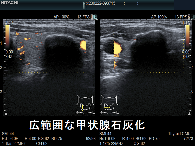 広範囲な甲状腺石灰化 超音波(エコー)画像 ドプラーモード 広範囲な甲状腺石灰化 超音波(エコー)画像 ドプラーモード