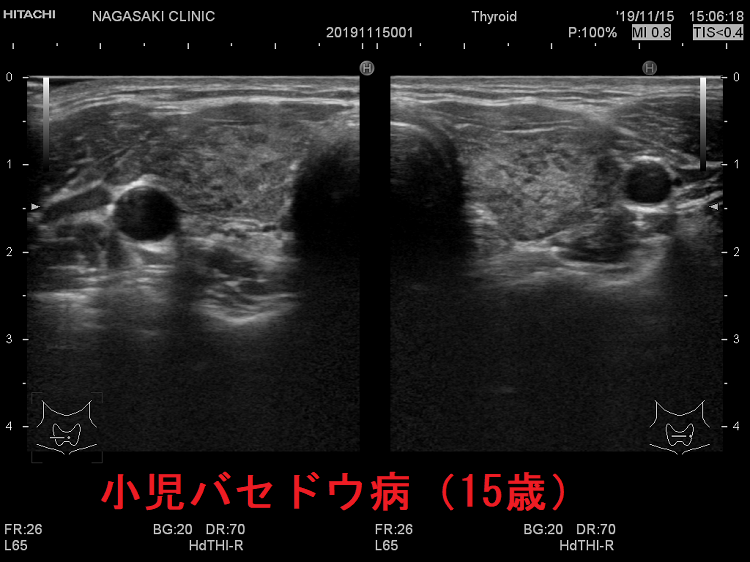 小児バセドウ病(15歳)超音波(エコー)画像 小児バセドウ病(15歳)超音波(エコー)画像