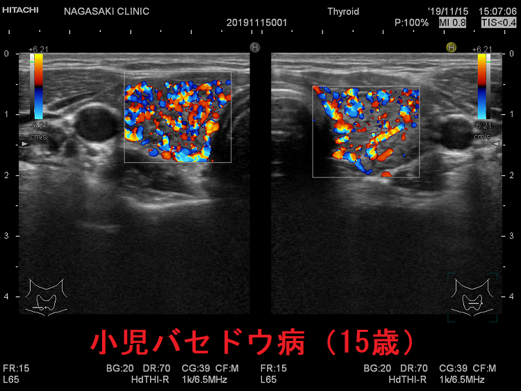 小児バセドウ病(15歳)超音波(エコー)画像 ドプラーモード 小児バセドウ病(15歳)超音波(エコー)画像 ドプラーモード