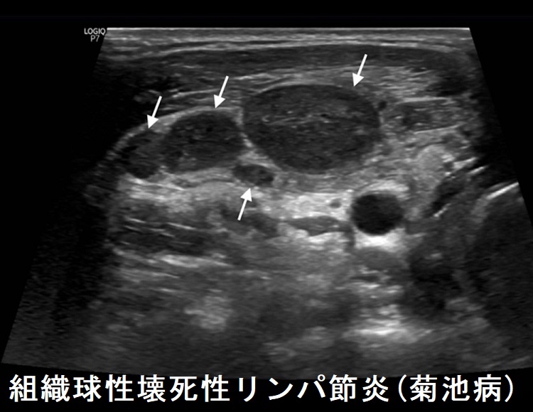 組織球性壊死性リンパ節炎(菊池病) 超音波(エコー)画像2 組織球性壊死性リンパ節炎(菊池病) 超音波(エコー)画像2