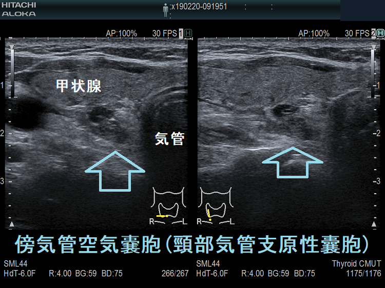 傍気管空気嚢胞(頸部気管支原性囊胞)超音波(エコー)画像 傍気管空気嚢胞(頸部気管支原性囊胞)超音波(エコー)画像