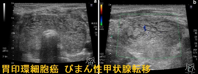 胃印環細胞癌 びまん性甲状腺転移 胃印環細胞癌 びまん性甲状腺転移