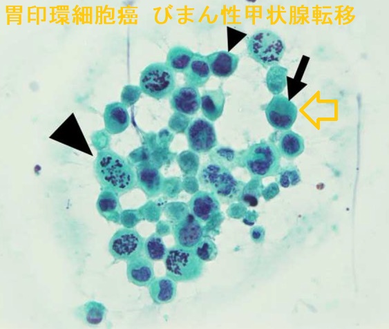 びまん性甲状腺転移 胃印環細胞癌 細胞診 びまん性甲状腺転移 胃印環細胞癌 細胞診