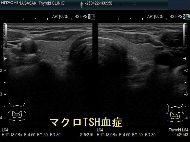 マクロTSH血症 超音波(エコー)画像 マクロTSH血症 超音波(エコー)画像
