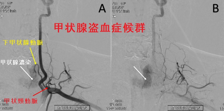 甲状腺盗血症候群 甲状腺盗血症候群