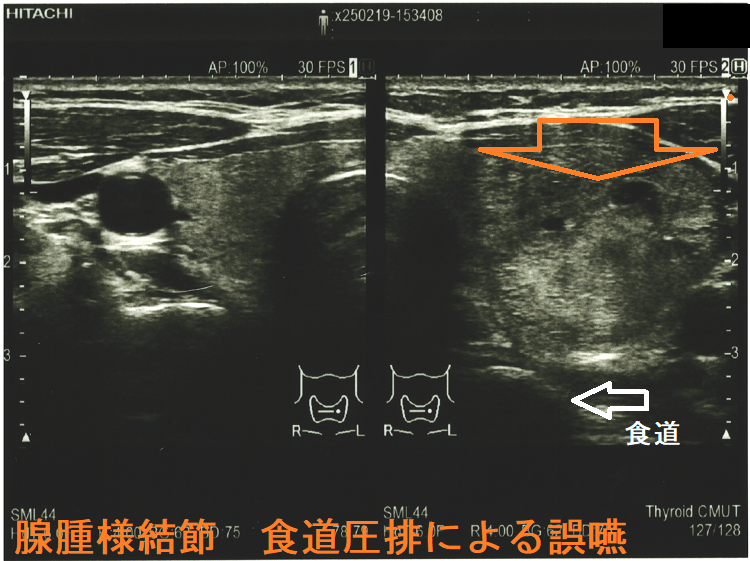 腺腫様結節 食道圧排による誤嚥 腺腫様結節 食道圧排による誤嚥 エコー1