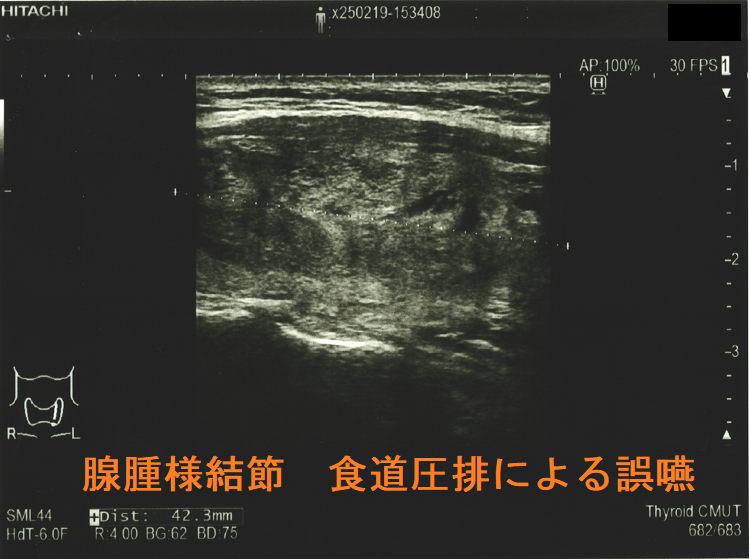 腺腫様結節 食道圧排による誤嚥(矢状断) 腺腫様結節 食道圧排による誤嚥(矢状断)