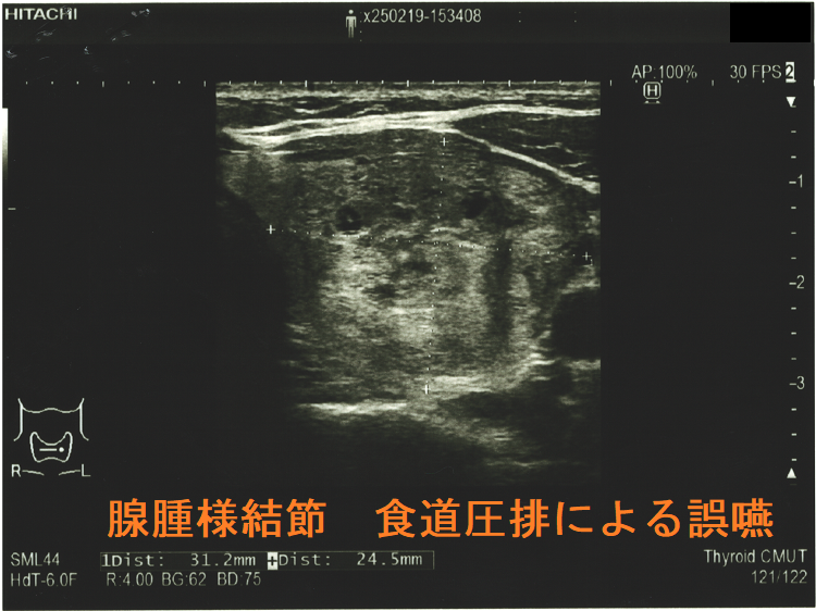 腺腫様結節 食道圧排による誤嚥(水平断) 腺腫様結節 食道圧排による誤嚥(水平断)