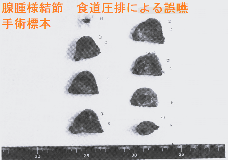 腺腫様結節 食道圧排による誤嚥 手術標本2 腺腫様結節 食道圧排による誤嚥 手術標本2-1