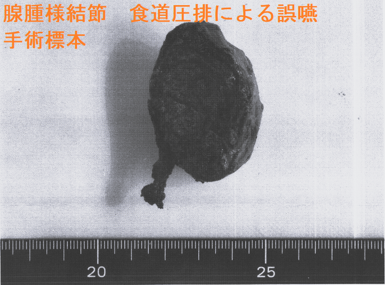 腺腫様結節 食道圧排による誤嚥 手術標本1 腺腫様結節 食道圧排による誤嚥 手術標本1-1