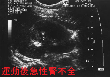 運動後急性腎不全 エコー画像 運動後急性腎不全 エコー画像