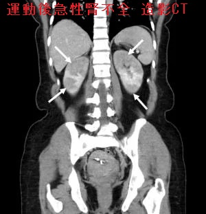 運動後急性腎不全 造影CT画像 運動後急性腎不全 造影CT画像