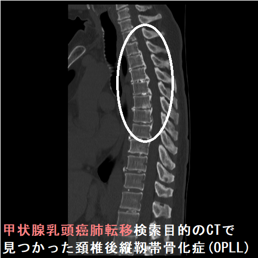 甲状腺乳頭癌の肺転移検索目的のCTで見つかった頚椎後縦靱帯骨化症(OPLL) 甲状腺乳頭癌の肺転移検索目的のCTで見つかった頚椎後縦靱帯骨化症(OPLL)
