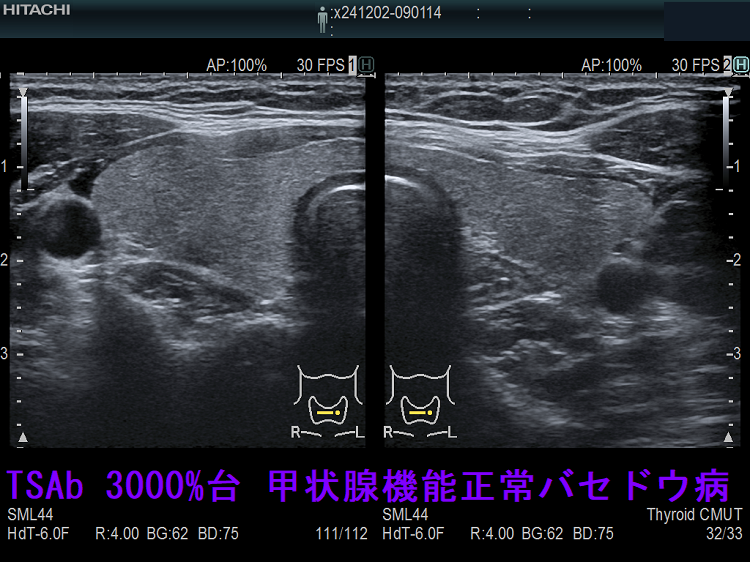 TSAb 3000%台 甲状腺機能正常バセドウ病 TSAb 3000%台 甲状腺機能正常バセドウ病