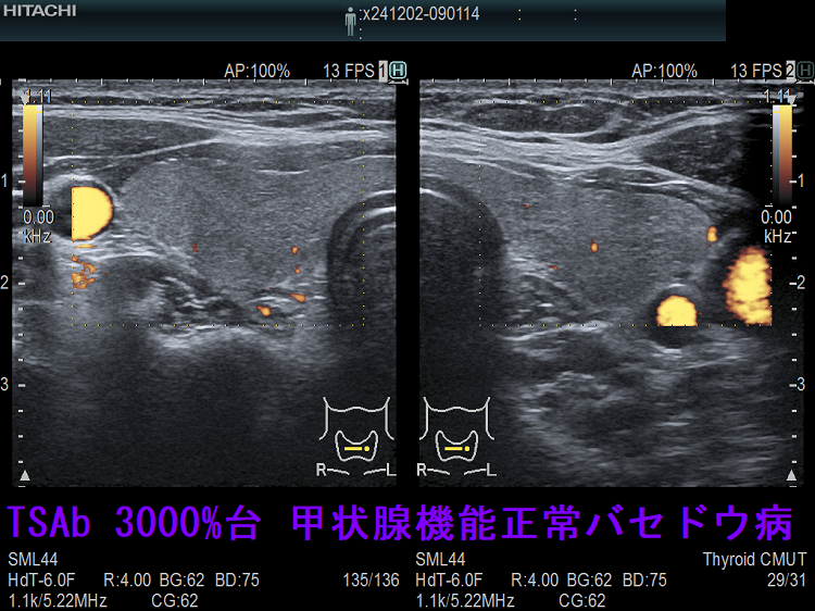 TSAb 3000%台 甲状腺機能正常バセドウ病 ドプラーモード TSAb 3000%台 甲状腺機能正常バセドウ病 ドプラーモード