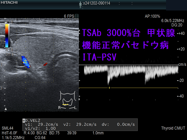 TSAb 3000%台 甲状腺機能正常バセドウ病 ITA-PSV TSAb 3000%台 甲状腺機能正常バセドウ病 ITA-PSV