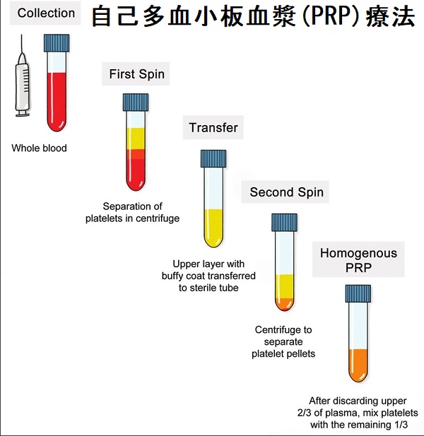 自己多血小板血漿(PRP)療法 自己多血小板血漿(PRP)療法