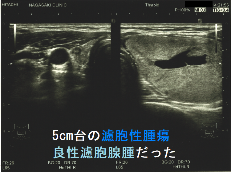 5cm台の濾胞性腫瘍 良性濾胞腺腫だった 全体像 5cm台の濾胞性腫瘍 良性濾胞腺腫だった 全体像