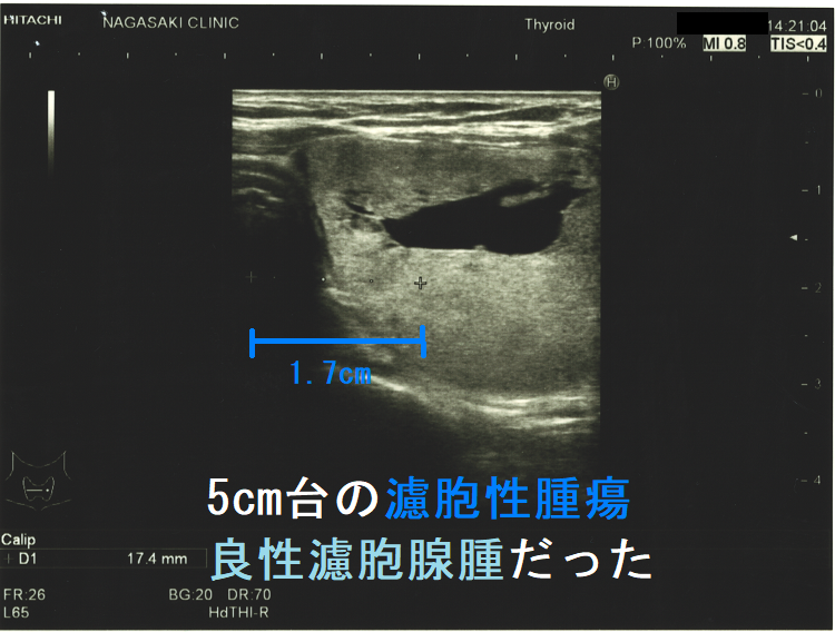 5cm台の濾胞性腫瘍 良性濾胞腺腫だった 気管偏位 5cm台の濾胞性腫瘍 良性濾胞腺腫だった 気管偏位