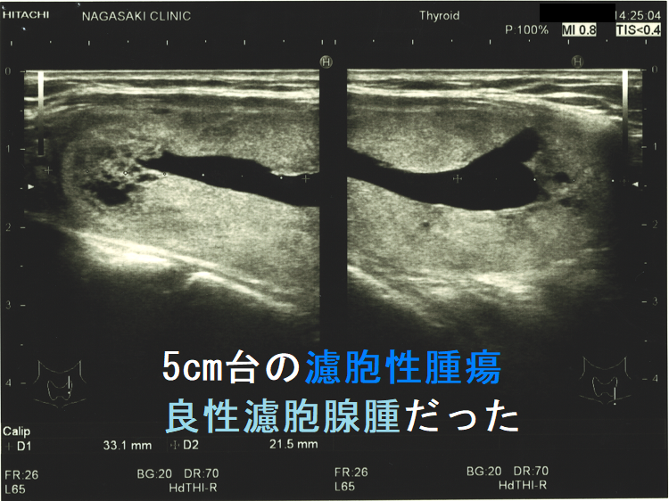 5cm台の濾胞性腫瘍 良性濾胞腺腫だった 矢状断 5cm台の濾胞性腫瘍 良性濾胞腺腫だった 矢状断