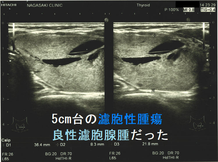 5cm台の濾胞性腫瘍 良性濾胞腺腫だった 水平断 5cm台の濾胞性腫瘍 良性濾胞腺腫だった 水平断