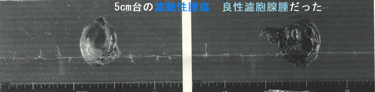 5cm台の濾胞性腫瘍 良性濾胞腺腫だった 手術標本1 5cm台の濾胞性腫瘍 良性濾胞腺腫だった 手術標本1