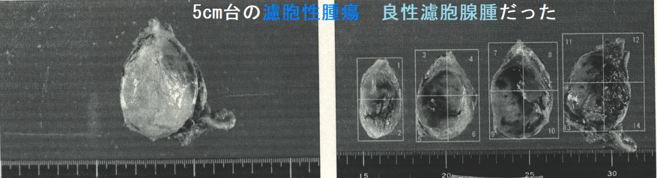 5cm台の濾胞性腫瘍 良性濾胞腺腫だった 手術標本2 5cm台の濾胞性腫瘍 良性濾胞腺腫だった 手術標本2