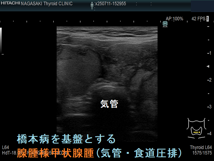 橋本病を基盤とする腺腫様甲状腺腫(気管・食道圧排) 橋本病を基盤とする腺腫様甲状腺腫(気管・食道圧排)