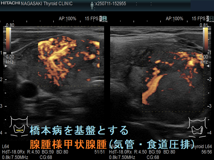 橋本病を基盤とする腺腫様甲状腺腫(気管・食道圧排) ドプラーモード 橋本病を基盤とする腺腫様甲状腺腫(気管・食道圧排) ドプラーモード