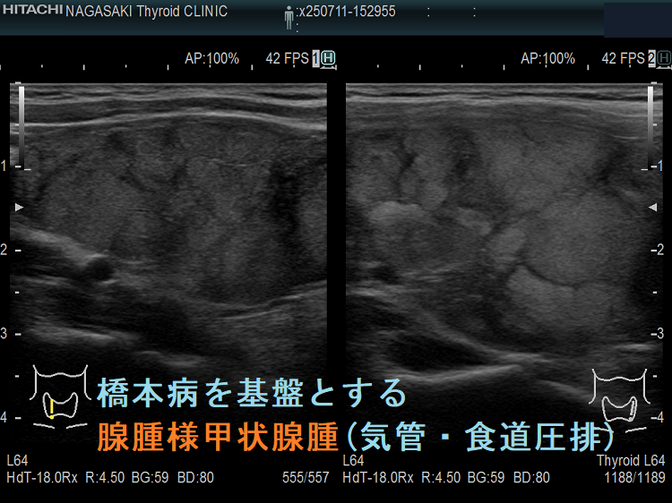 橋本病を基盤とする腺腫様甲状腺腫(気管・食道圧排) 矢状断 橋本病を基盤とする腺腫様甲状腺腫(気管・食道圧排) 矢状断