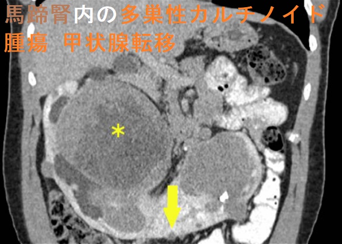 馬蹄腎内の多巣性カルチノイド腫瘍 甲状腺転移 造影CT画像 馬蹄腎内の多巣性カルチノイド腫瘍 甲状腺転移 造影CT画像