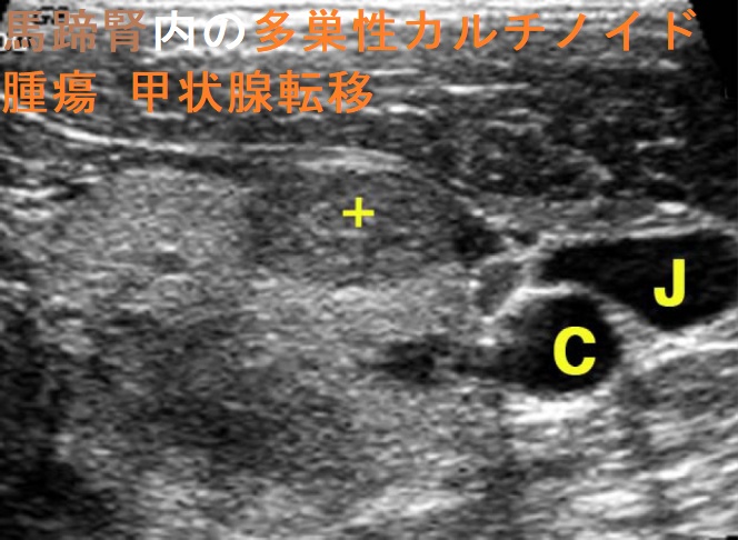 馬蹄腎内の多巣性カルチノイド腫瘍 甲状腺転移 超音波(エコー)画像 馬蹄腎内の多巣性カルチノイド腫瘍 甲状腺転移 超音波(エコー)画像