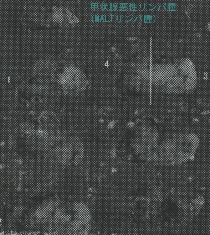 甲状腺悪性リンパ腫(MALTリンパ腫) 手術標本 甲状腺悪性リンパ腫(MALTリンパ腫) 手術標本