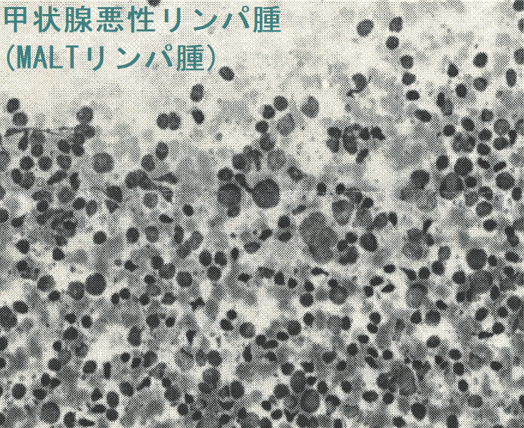 甲状腺悪性リンパ腫(MALTリンパ腫) 細胞診 甲状腺悪性リンパ腫(MALTリンパ腫) 細胞診