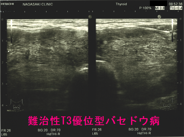 難治性T3優位型バセドウ病(水平断) 難治性T3優位型バセドウ病(水平断)