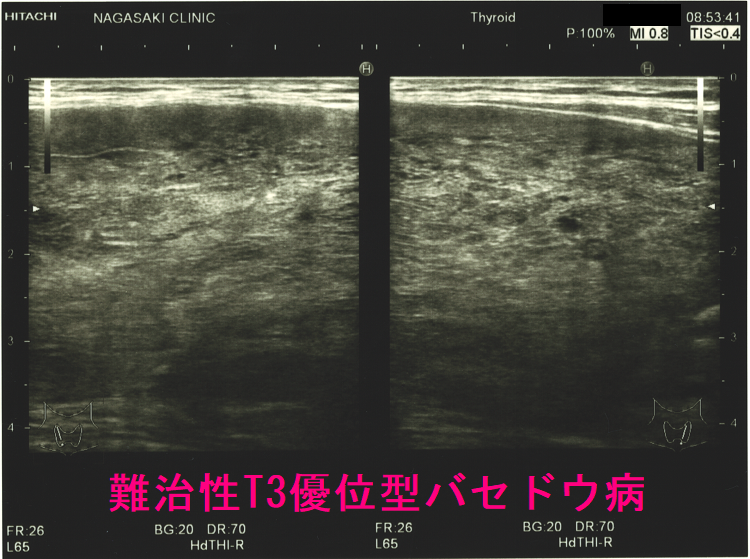 難治性T3優位型バセドウ病(矢状断) 難治性T3優位型バセドウ病(矢状断)