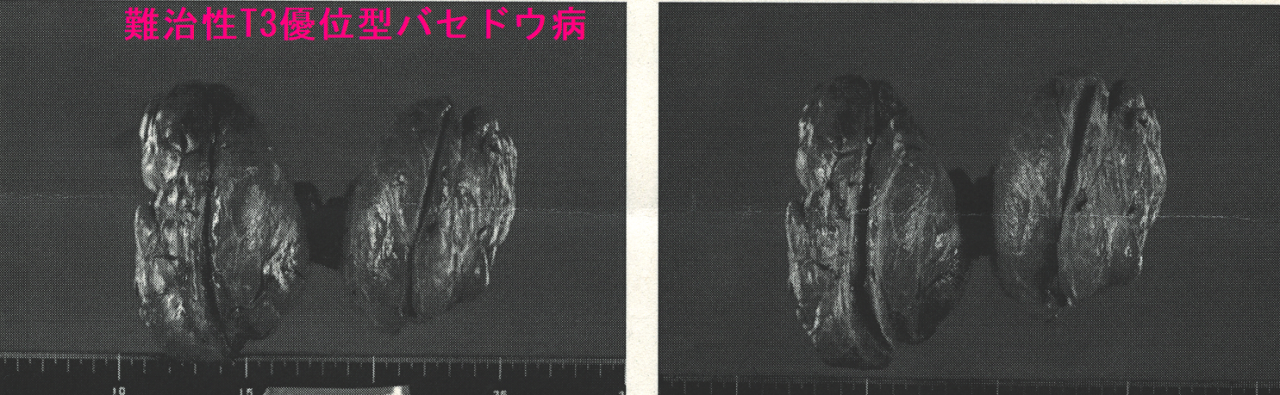 難治性T3優位型バセドウ病 手術標本1 難治性T3優位型バセドウ病 手術標本1