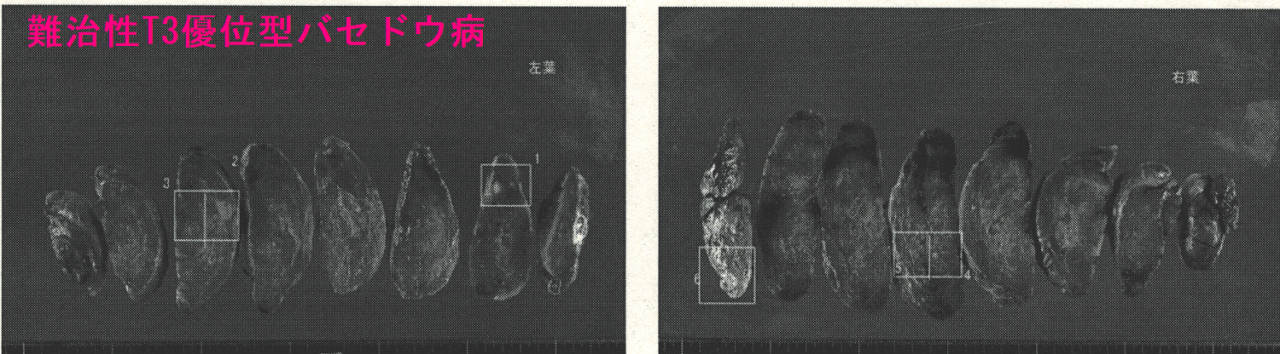 難治性T3優位型バセドウ病 手術標本2 難治性T3優位型バセドウ病 手術標本2