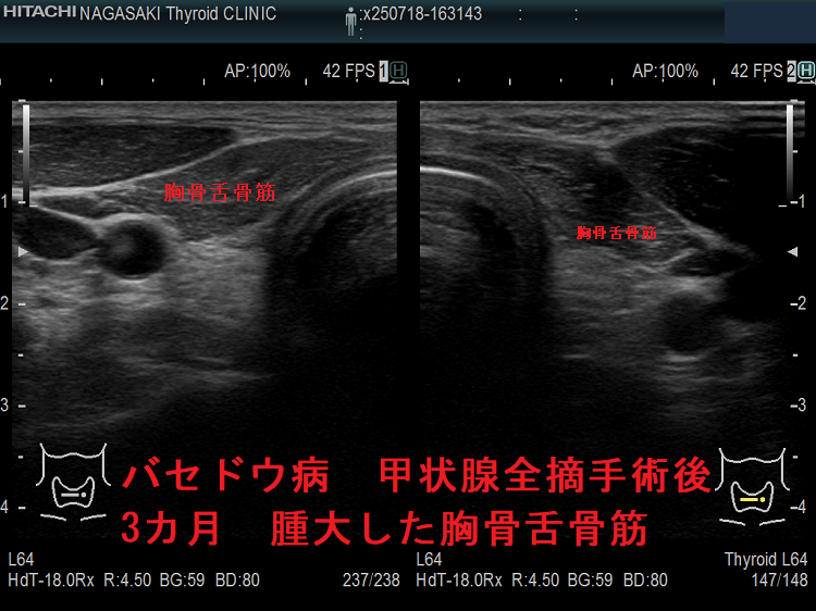 バセドウ病 甲状腺全摘手術後3カ月 腫大した胸骨舌骨筋 バセドウ病 甲状腺全摘手術後3カ月 腫大した胸骨舌骨筋