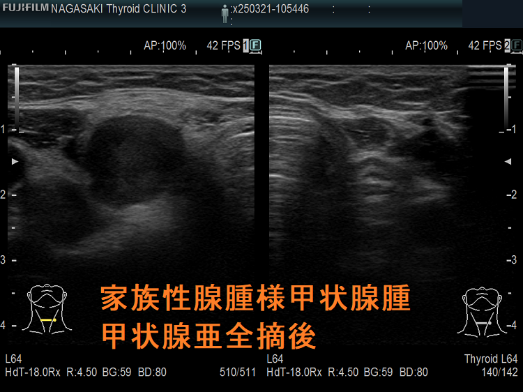 家族性腺腫様甲状腺腫(家族性多結節性甲状腺腫) 甲状腺亜全摘後 家族性腺腫様甲状腺腫(家族性多結節性甲状腺腫) 甲状腺亜全摘後