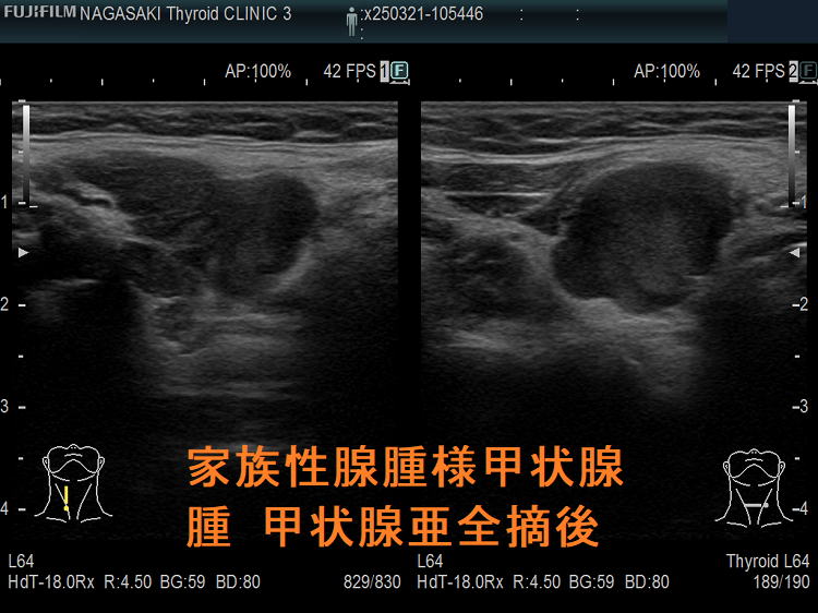 家族性腺腫様甲状腺腫(家族性多結節性甲状腺腫) 甲状腺亜全摘後2 家族性腺腫様甲状腺腫(家族性多結節性甲状腺腫) 甲状腺亜全摘後2